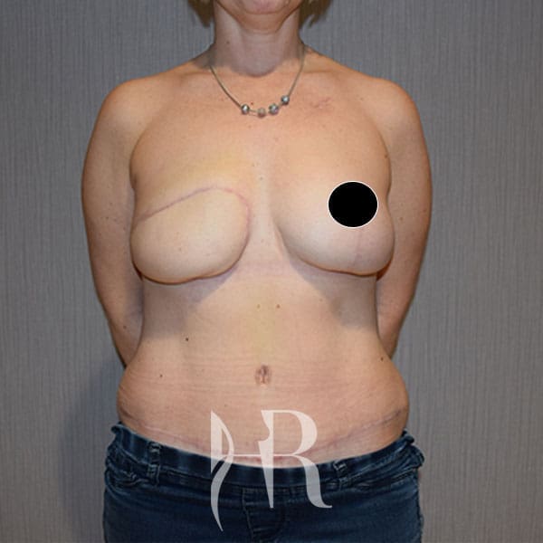 HR Plastic Surgery - Breast Reconstruction patient after 7